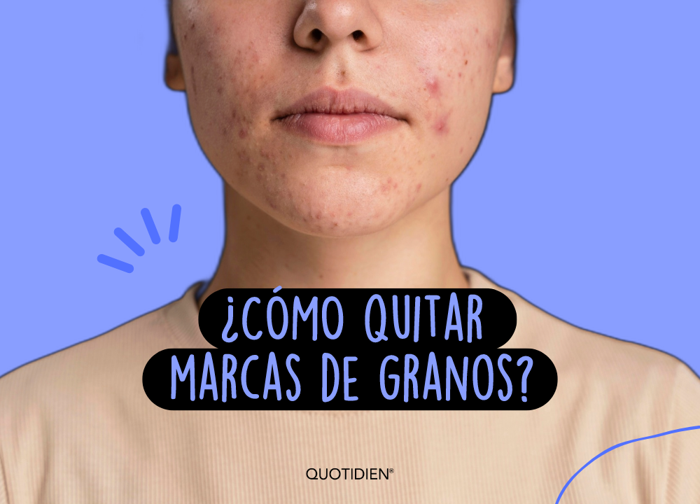 ¿Cómo quitar marcas de granos y disfrutar de una piel sin cicatrices?