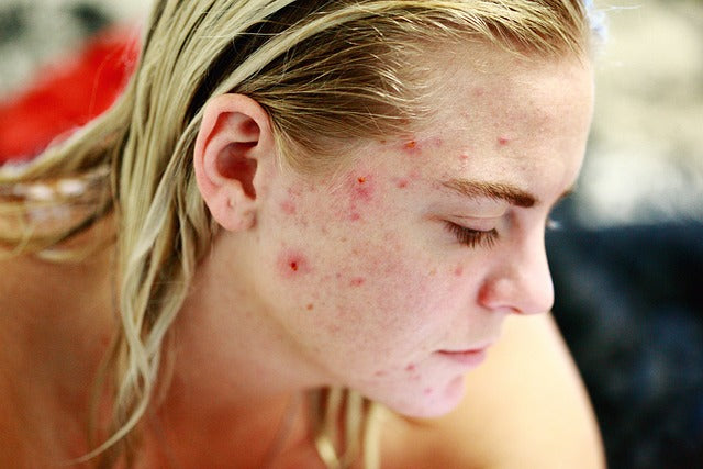 ¿Granos en la cara? Guía completa para eliminar las imperfecciones faciales y lograr una piel de ensueño